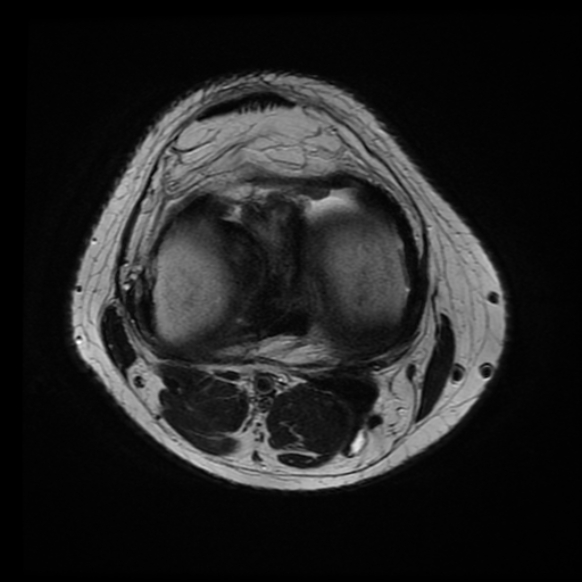 File:Anterior cruciate ligament tear with posteromedial corner injury, bucket-handle meniscal tear and chondral delamination (Radiopaedia 75501-86744 Axial T2 10).jpg