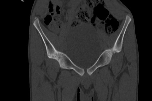 Anterior inferior iliac spine avulsion injury (Radiopaedia 88666-105376 Coronal bone window 23).jpg
