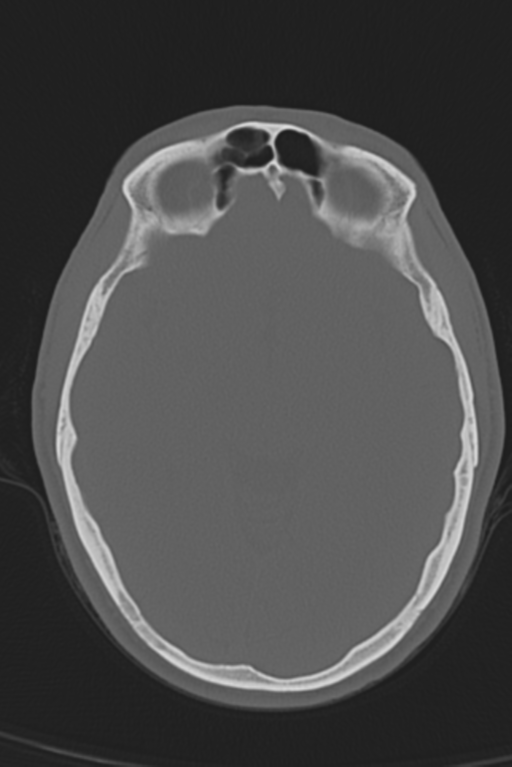 Anterior nasal spine fracture (Radiopaedia 46138-50494 Axial bone window 33).png