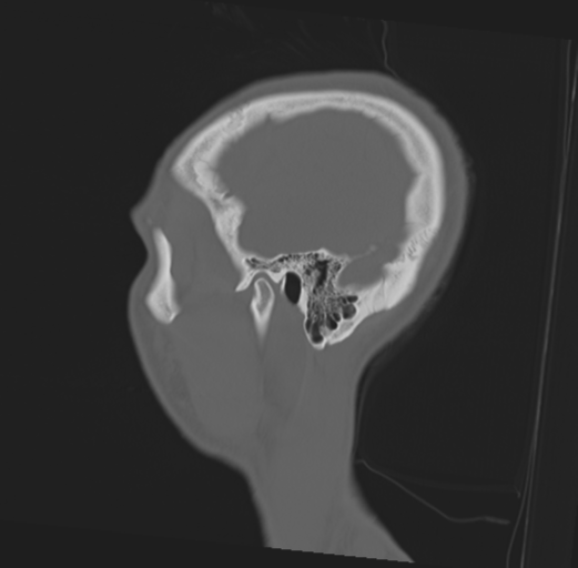 Anterior nasal spine fracture (Radiopaedia 46138-50494 Sagittal bone window 11).png