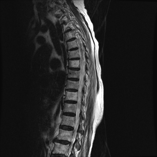 File:Anterior spinal artery syndrome (Radiopaedia 46335-50750 C 3).png