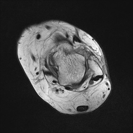 File:Anterior talofibular ligament injury - rupture with soft-tissue impingement (Radiopaedia 38765-40928 Axial PD 18).jpg