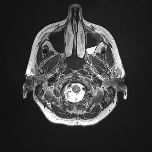 File:Anterior temporal encephalocele (Radiopaedia 82624-96808 Axial T2 1).jpg