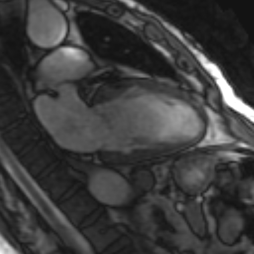 File:Anteroseptal hypokinesia after myocardial infarction (Radiopaedia 15978-15633 2 chamber view SSFE 16).jpg