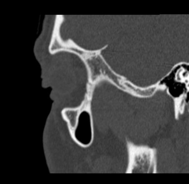 Antrochoanal polyp (Radiopaedia 33984-35202 Sagittal bone window 76).jpg