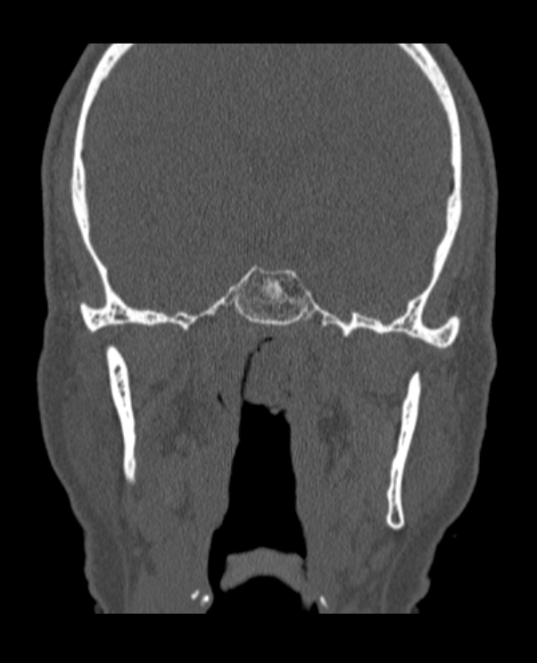 Antrochoanal polyp (Radiopaedia 79011-92169 Coronal bone window 6).jpg