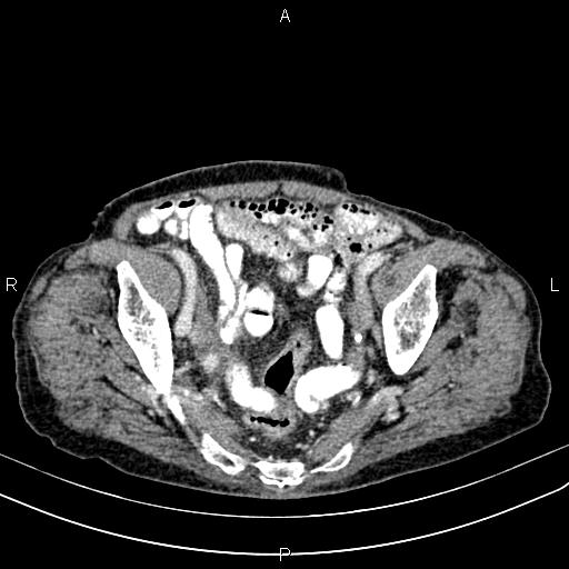 File:Aortic aneurysm and Lemmel syndrome (Radiopaedia 86499-102554 A 67).jpg