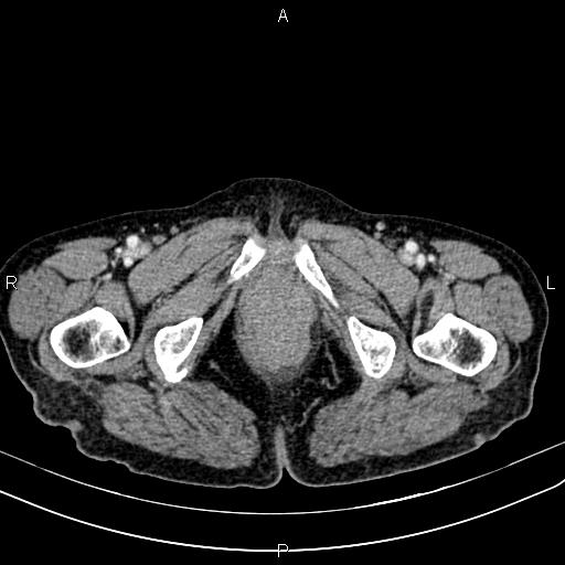 File:Aortic aneurysm and Lemmel syndrome (Radiopaedia 86499-102554 A 86).jpg