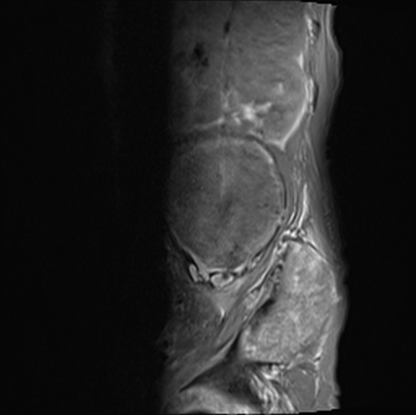 File:Aortic aneurysm with spinal destruction (Radiopaedia 42301-45409 Sagittal T1 fat sat 11).jpg
