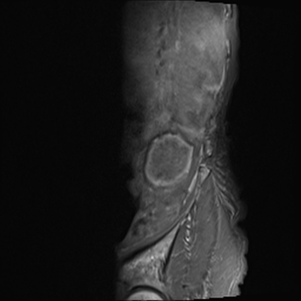 File:Aortic aneurysm with spinal destruction (Radiopaedia 42301-45409 Sagittal T1 fat sat 4).jpg