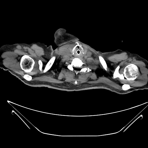 Aortic arch aneurysm (Radiopaedia 84109-99365 Axial non-contrast 7).jpg