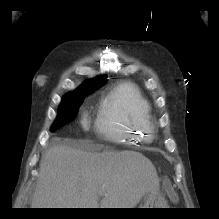 Aortic arch graft infection (FDG PET-CT) (Radiopaedia 71975-82437 Coronal 14).jpg