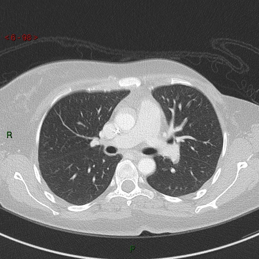 Aortic arch origin of left vertebral artery (Radiopaedia 51520-57286 Axial lung window 98).jpg