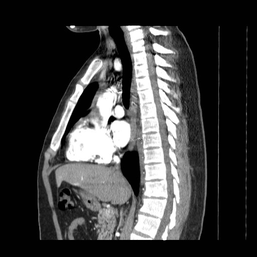 File:Aortic arch stent (Radiopaedia 30030-30595 E 6).jpg