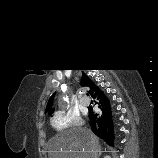File:Aortic dissection- Stanford A (Radiopaedia 35729-37268 D 42).jpg