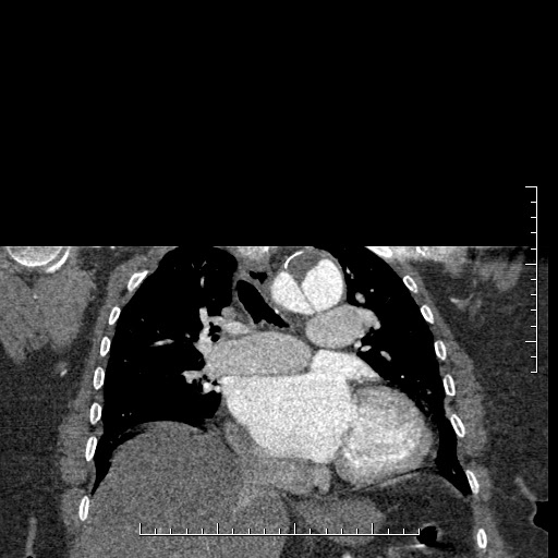File:Aortic dissection- Stanford A (Radiopaedia 35729-37268 E 28).jpg