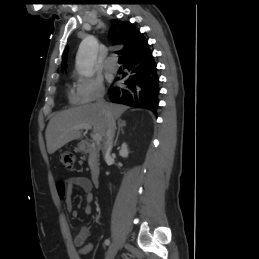 File:Aortic dissection- Stanford A (Radiopaedia 37759-39664 Sagittal C+ delayed 8).png