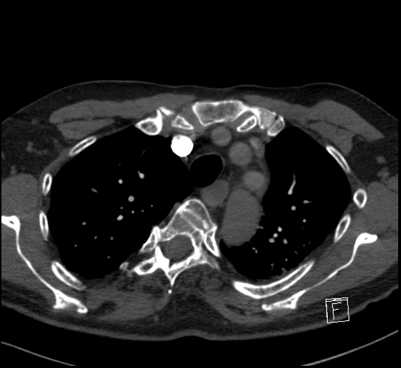 File:Aortic dissection (CTPA) (Radiopaedia 75506-86751 Axial C+ CTPA 33).jpg