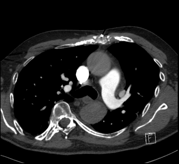 File:Aortic dissection (CTPA) (Radiopaedia 75506-86751 Axial C+ CTPA 57).jpg