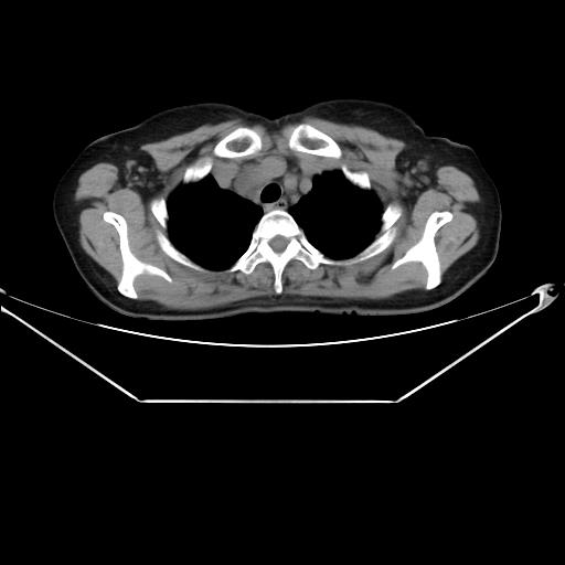 Aortic dissection (Radiopaedia 25350-25604 B 11).jpg
