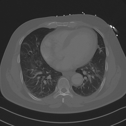 Aortic dissection (Radiopaedia 50763-56234 Axial bone window 67).png