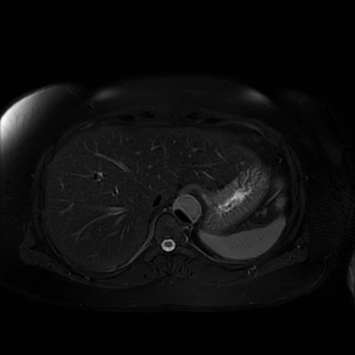 File:Aortic dissection (Radiopaedia 57969-64956 Axial T2 fat sat 16).jpg