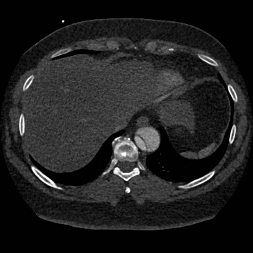 Aortic dissection (Radiopaedia 57969-64959 A 249).jpg