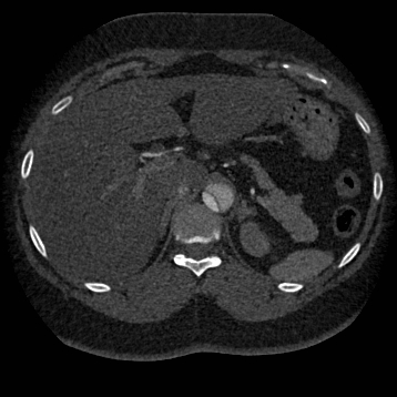 Aortic dissection (Radiopaedia 57969-64959 A 318).jpg