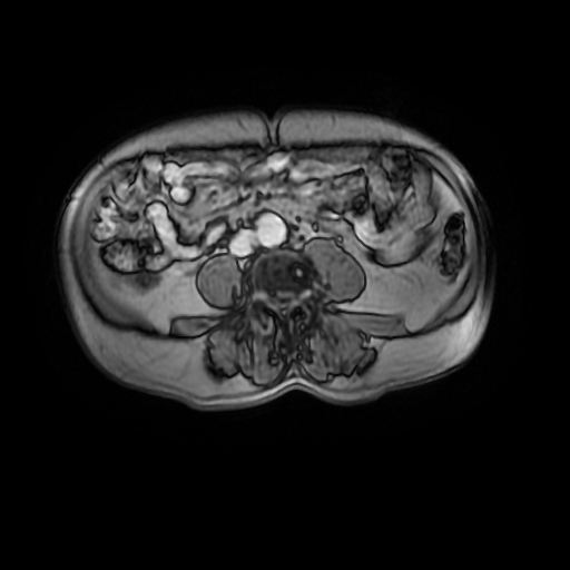 File:Aortic dissection - Stanford A - DeBakey I (Radiopaedia 23469-23551 Axial MRA 65).jpg