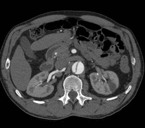 Aortic dissection - Stanford type B (Radiopaedia 73648-84437 A 140).jpg