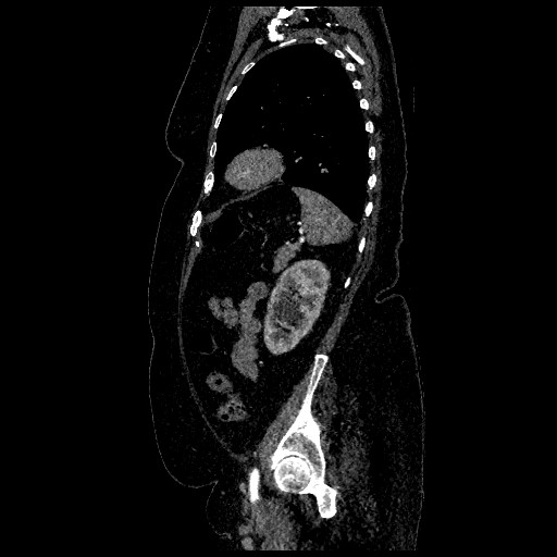 File:Aortic dissection - Stanford type B (Radiopaedia 88281-104910 C 68).jpg