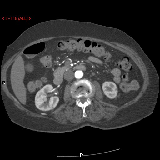 Aortic intramural hematoma (Radiopaedia 27746-28001 A 115).jpg