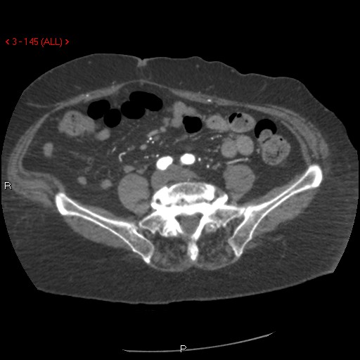 Aortic intramural hematoma (Radiopaedia 27746-28001 A 145).jpg