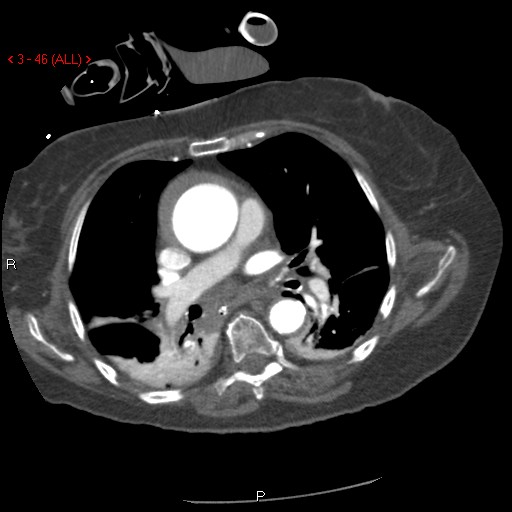 Aortic intramural hematoma (Radiopaedia 27746-28001 A 46).jpg
