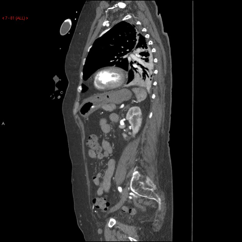 Aortic intramural hematoma (Radiopaedia 27746-28001 C 50).jpg