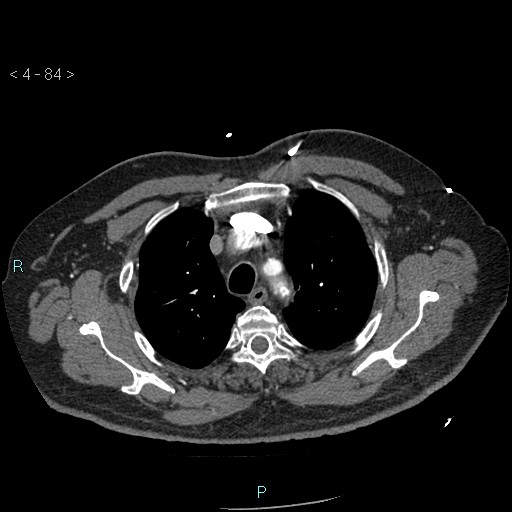 File:Aortic intramural hematoma (Radiopaedia 48463-53380 B 38).jpg