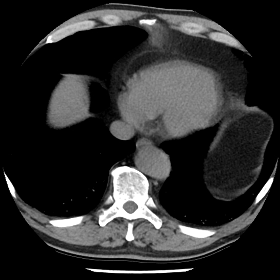 File:Aortic intramural hematoma (type B) (Radiopaedia 79323-92387 Axial non-contrast 42).jpg