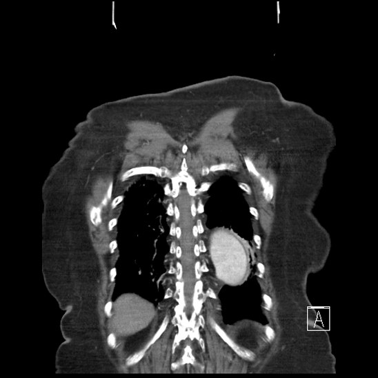 Aortic intramural hematoma with dissection and intramural blood pool (Radiopaedia 77373-89491 C 58).jpg