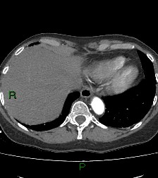 Aortic valve endocarditis (Radiopaedia 87209-103485 C 79).jpg