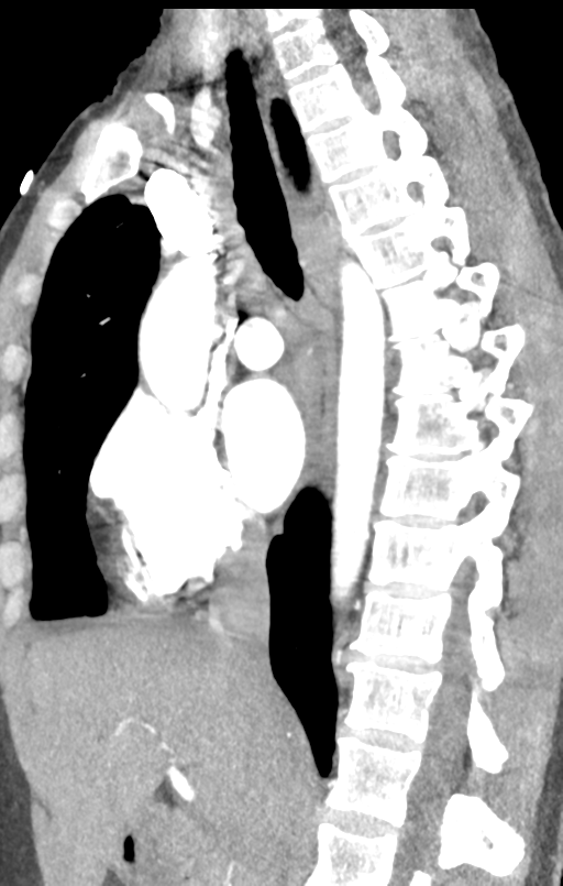 Aortic valve non-coronary cusp thrombus (Radiopaedia 55661-62189 C+ arterial phase 33).png