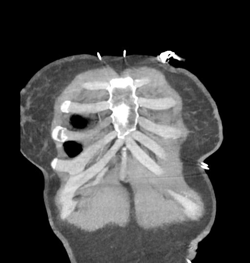 Aortic valve non-coronary cusp thrombus (Radiopaedia 55661-62189 C 10).png