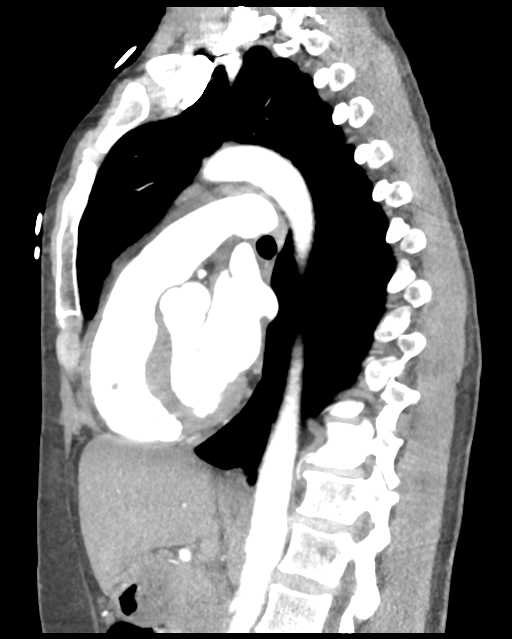 Aortic valve non-coronary cusp thrombus (Radiopaedia 55661-62189 D 25).png