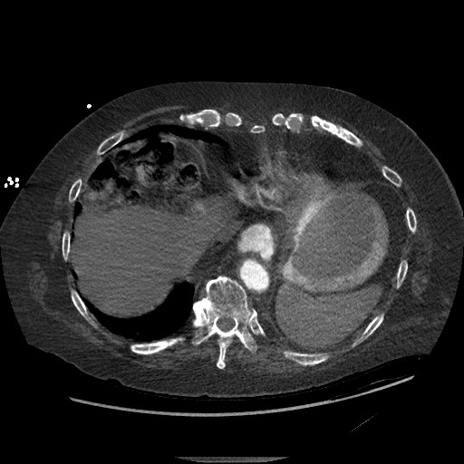 File:Aortoesophageal fistula with endovascular repair (Radiopaedia 73781-84592 Axial C+ CTPA 139).jpg
