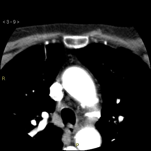 Aortoiliac occlusive disease (Radiopaedia 16828-16548 A 9).jpg