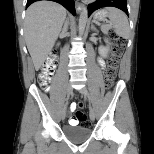 File:Appendicitis complicated by post-operative collection (Radiopaedia 35595-37113 B 30).jpg