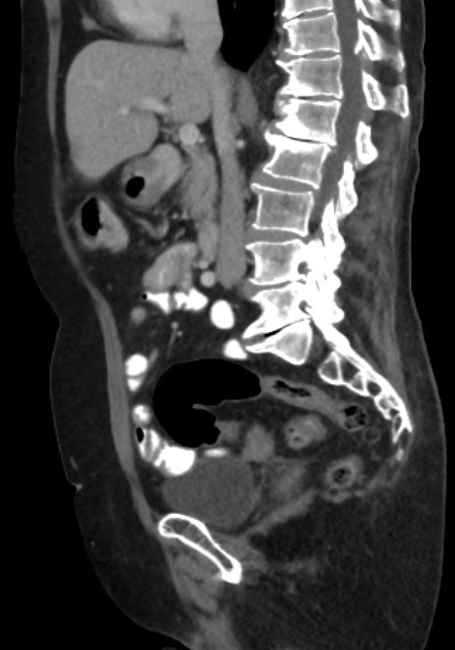Appendicitis due to chicken fibula (Radiopaedia 74314-85198 C 45).jpg