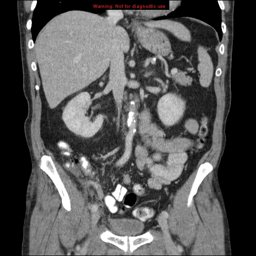 File:Appendicitis mass in inguinal hernia (Radiopaedia 26858-27029 B 34).jpg