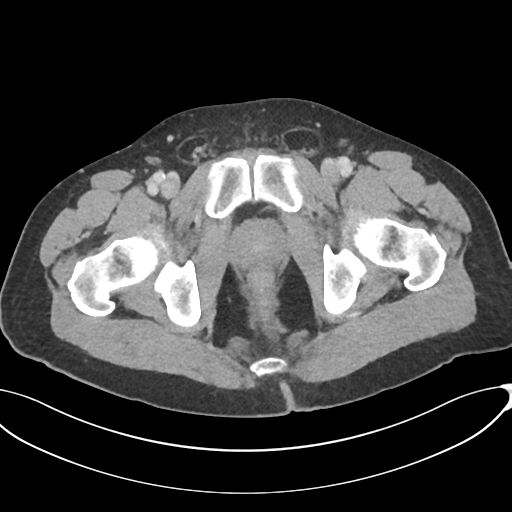 Appendicitis with thickening of the terminal ileum (Radiopaedia 42432-45550 A 96).png