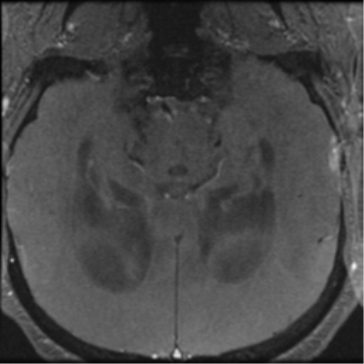 File:Aqueduct stenosis with corpus callosum hypoattenuation post shunting (Radiopaedia 37212-38969 Axial CSF Flow 33).png