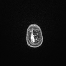 Aqueductal stenosis (Radiopaedia 73974-84802 Axial T1 C+ 139).jpg